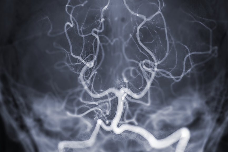 Aneurisma cerebral en una arteria del cerebro y evaluación en consulta médica neurología y neurocirugía. Puerto Montt