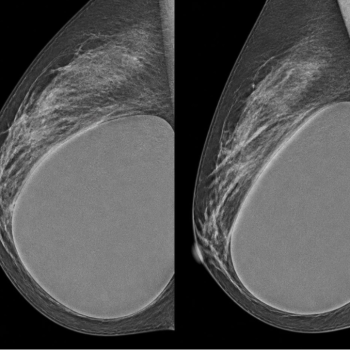 Mamografía realizada a una mujer con implantes mamarios durante un control preventivo.