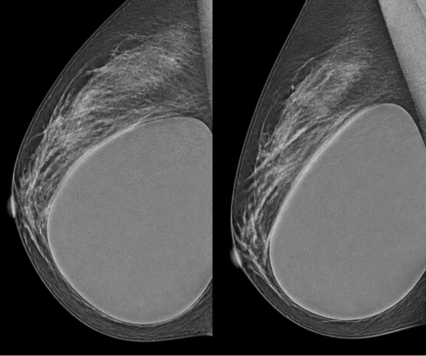 Mamografía realizada a una mujer con implantes mamarios durante un control preventivo.